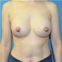 Breast Augmentation After Photo by Joshua Cooper, MD; ,  - Case 50276