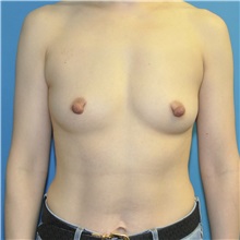Breast Augmentation Before Photo by Joshua Cooper, MD; ,  - Case 50276