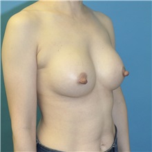 Breast Augmentation After Photo by Joshua Cooper, MD; ,  - Case 50276