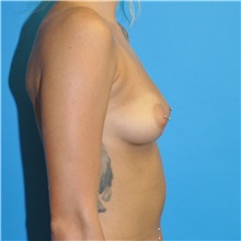 Breast Augmentation Before Photo by Joshua Cooper, MD; ,  - Case 50391