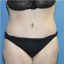 Tummy Tuck After Photo by Joshua Cooper, MD; ,  - Case 50435