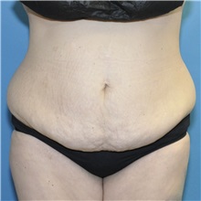 Tummy Tuck Before Photo by Joshua Cooper, MD; ,  - Case 50435