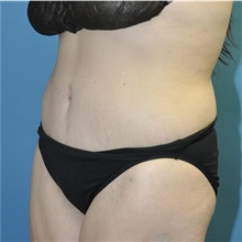Tummy Tuck After Photo by Joshua Cooper, MD; ,  - Case 50435