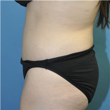 Tummy Tuck After Photo by Joshua Cooper, MD; ,  - Case 50435