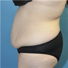 Tummy Tuck Before Photo by Joshua Cooper, MD; ,  - Case 50435