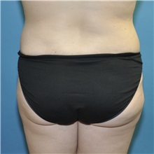 Tummy Tuck After Photo by Joshua Cooper, MD; ,  - Case 50435