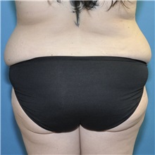 Tummy Tuck Before Photo by Joshua Cooper, MD; ,  - Case 50435