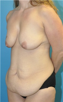 Mommy Makeover Before Photo by Joshua Cooper, MD; ,  - Case 50471