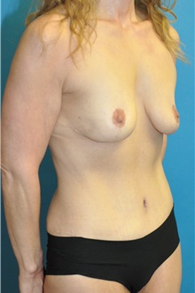 Mommy Makeover After Photo by Joshua Cooper, MD; ,  - Case 50471