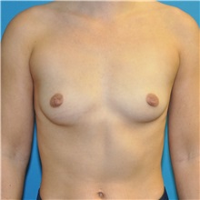 Breast Augmentation Before Photo by Joshua Cooper, MD; ,  - Case 50571
