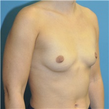 Breast Augmentation Before Photo by Joshua Cooper, MD; ,  - Case 50628