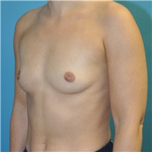 Breast Augmentation Before Photo by Joshua Cooper, MD; ,  - Case 50628