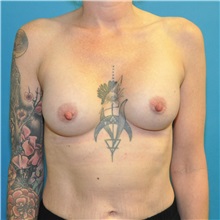 Breast Augmentation After Photo by Joshua Cooper, MD; ,  - Case 50630