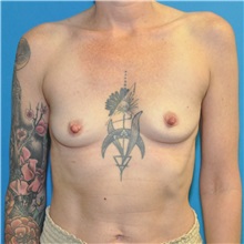 Breast Augmentation Before Photo by Joshua Cooper, MD; ,  - Case 50630