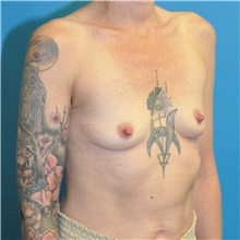 Breast Augmentation Before Photo by Joshua Cooper, MD; ,  - Case 50630