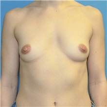 Breast Augmentation Before Photo by Joshua Cooper, MD; Seattle, WA - Case 50725