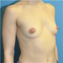 Breast Augmentation Before Photo by Joshua Cooper, MD; Seattle, WA - Case 50725