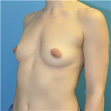 Breast Augmentation Before Photo by Joshua Cooper, MD; Seattle, WA - Case 50725