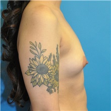 Breast Augmentation Before Photo by Joshua Cooper, MD; Seattle, WA - Case 50758