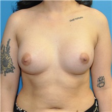 Breast Augmentation After Photo by Joshua Cooper, MD; Seattle, WA - Case 50758