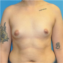Breast Augmentation Before Photo by Joshua Cooper, MD; Seattle, WA - Case 50758