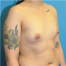 Breast Augmentation Before Photo by Joshua Cooper, MD; Seattle, WA - Case 50758