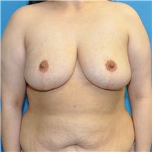 Breast Reduction After Photo by Joshua Cooper, MD; Seattle, WA - Case 50783
