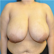 Breast Reduction Before Photo by Joshua Cooper, MD; Seattle, WA - Case 50783