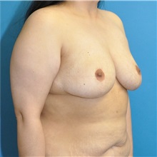 Breast Reduction After Photo by Joshua Cooper, MD; Seattle, WA - Case 50783