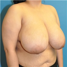 Breast Reduction Before Photo by Joshua Cooper, MD; Seattle, WA - Case 50783