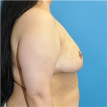 Breast Reduction After Photo by Joshua Cooper, MD; Seattle, WA - Case 50783