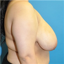 Breast Reduction Before Photo by Joshua Cooper, MD; Seattle, WA - Case 50783