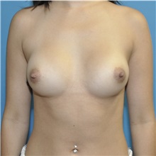 Breast Augmentation After Photo by Joshua Cooper, MD; Seattle, WA - Case 51128