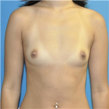 Breast Augmentation Before Photo by Joshua Cooper, MD; Seattle, WA - Case 51128