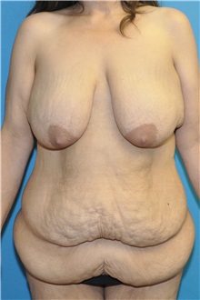 Body Lift Before Photo by Joshua Cooper, MD; Seattle, WA - Case 51448