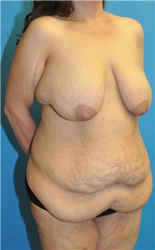 Body Lift Before Photo by Joshua Cooper, MD; Seattle, WA - Case 51448