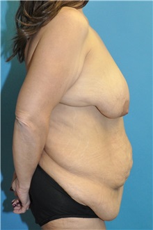 Body Lift Before Photo by Joshua Cooper, MD; Seattle, WA - Case 51448