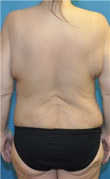 Body Lift Before Photo by Joshua Cooper, MD; Seattle, WA - Case 51448