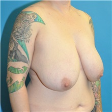 Breast Reduction Before Photo by Joshua Cooper, MD; Seattle, WA - Case 51550