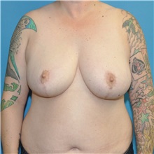 Breast Reduction After Photo by Joshua Cooper, MD; Seattle, WA - Case 51550