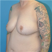 Breast Reduction After Photo by Joshua Cooper, MD; Seattle, WA - Case 51550