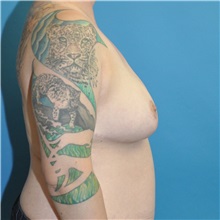 Breast Reduction After Photo by Joshua Cooper, MD; Seattle, WA - Case 51550