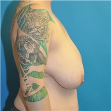 Breast Reduction Before Photo by Joshua Cooper, MD; Seattle, WA - Case 51550