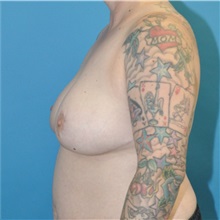 Breast Reduction After Photo by Joshua Cooper, MD; Seattle, WA - Case 51550