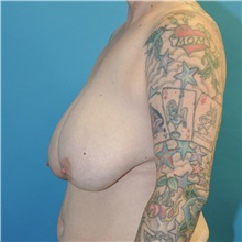 Breast Reduction Before Photo by Joshua Cooper, MD; Seattle, WA - Case 51550