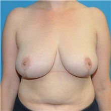 Breast Reduction After Photo by Joshua Cooper, MD, FACS; SEATTLE, WA - Case 51603