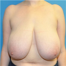 Breast Reduction Before Photo by Joshua Cooper, MD, FACS; SEATTLE, WA - Case 51603