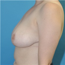 Breast Reduction After Photo by Joshua Cooper, MD, FACS; SEATTLE, WA - Case 51603