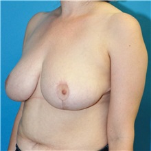 Breast Reduction After Photo by Joshua Cooper, MD, FACS; SEATTLE, WA - Case 51603