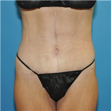 Body Lift After Photo by Joshua Cooper, MD, FACS; SEATTLE, WA - Case 51608